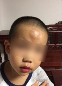 男童被送快遞的電動(dòng)車撞飛一米多，額頭腫起乒乓球大的包